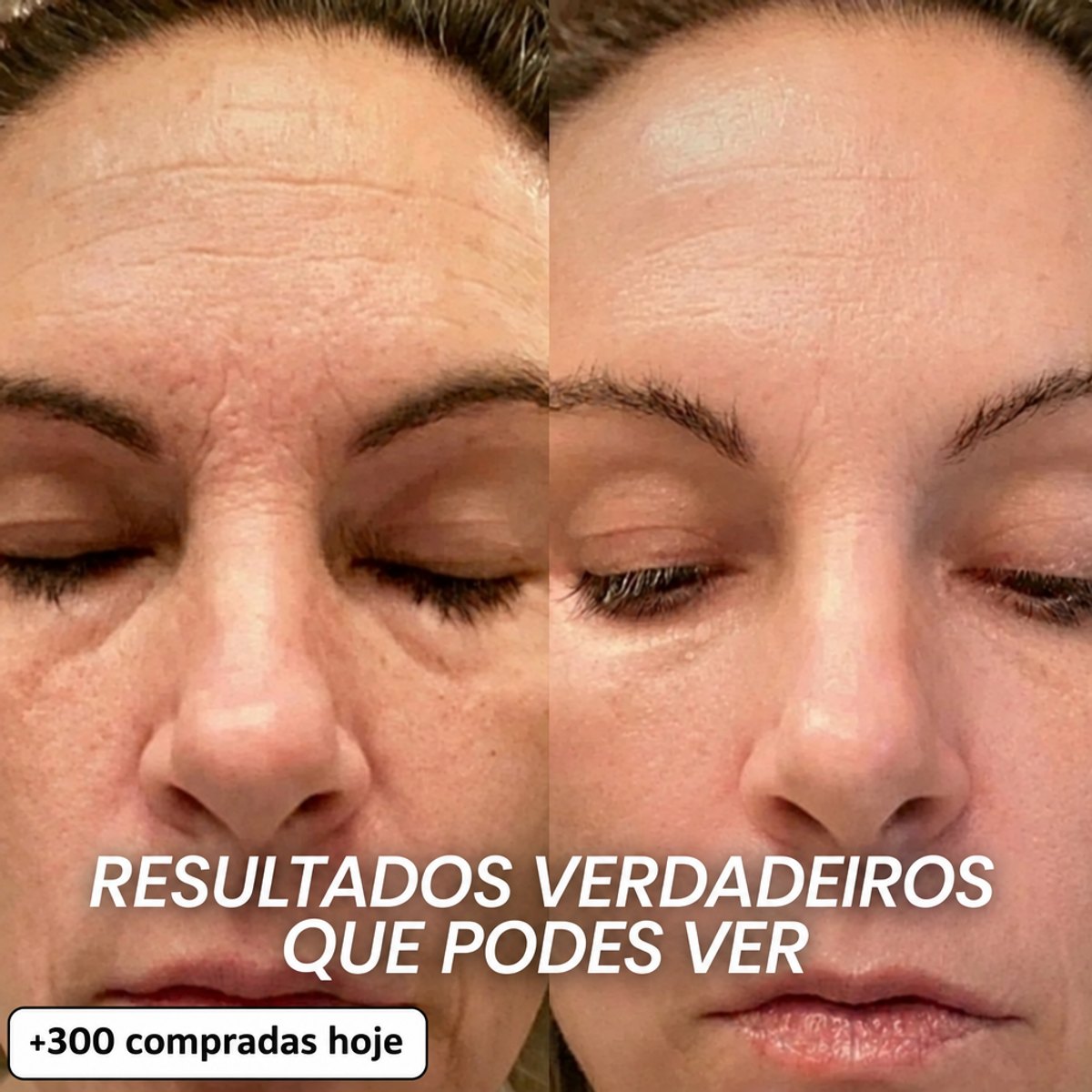 Ilou Skin Stick Preenchedor Bio-Colagénio PDRN